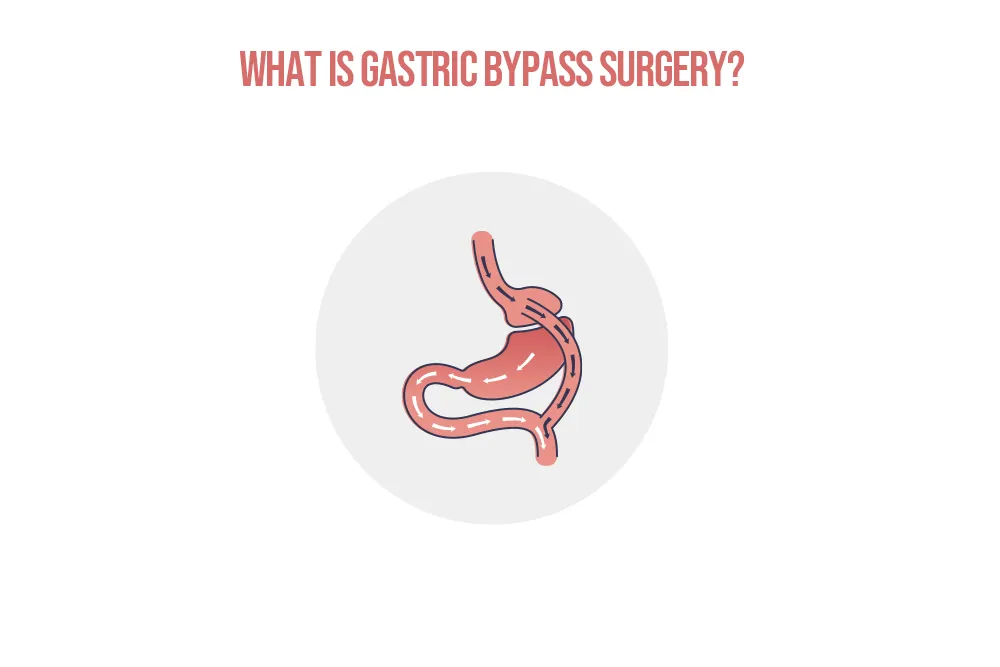 What-is-Gastric-Bypass-Surgery.webp
