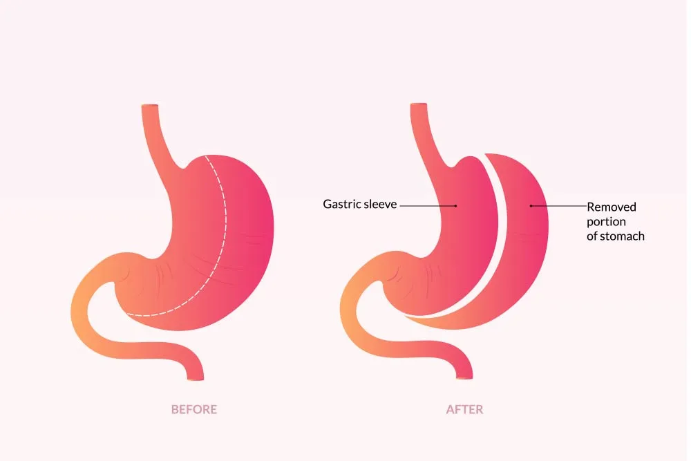 What-is-Gastric-Sleeve-Surgery-1.webp
