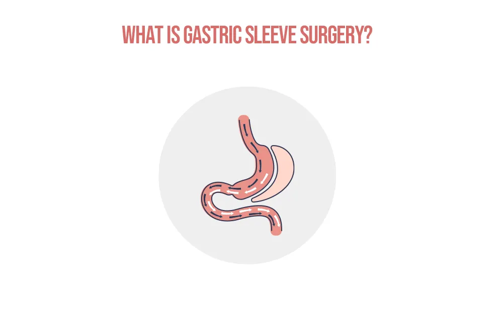 What-is-Gastric-Sleeve-Surgery-2.webp
