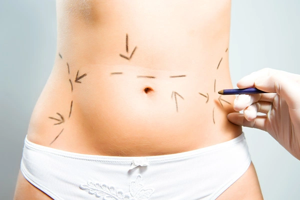 What is a Mini Tummy Tuck?