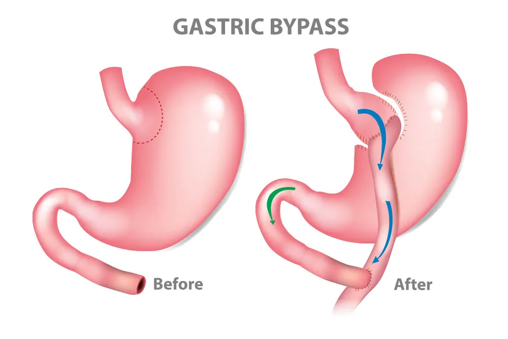 What-is-a-gastric-bypass.webp
