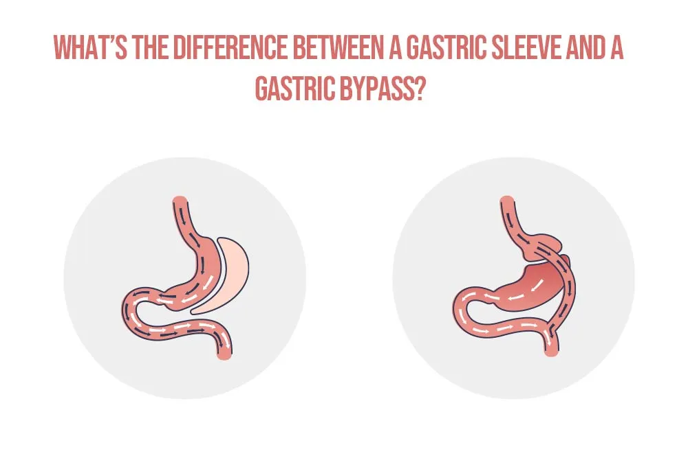 Whats-the-difference-between-a-gastric-sleeve-and-a-gastric-bypass.webp