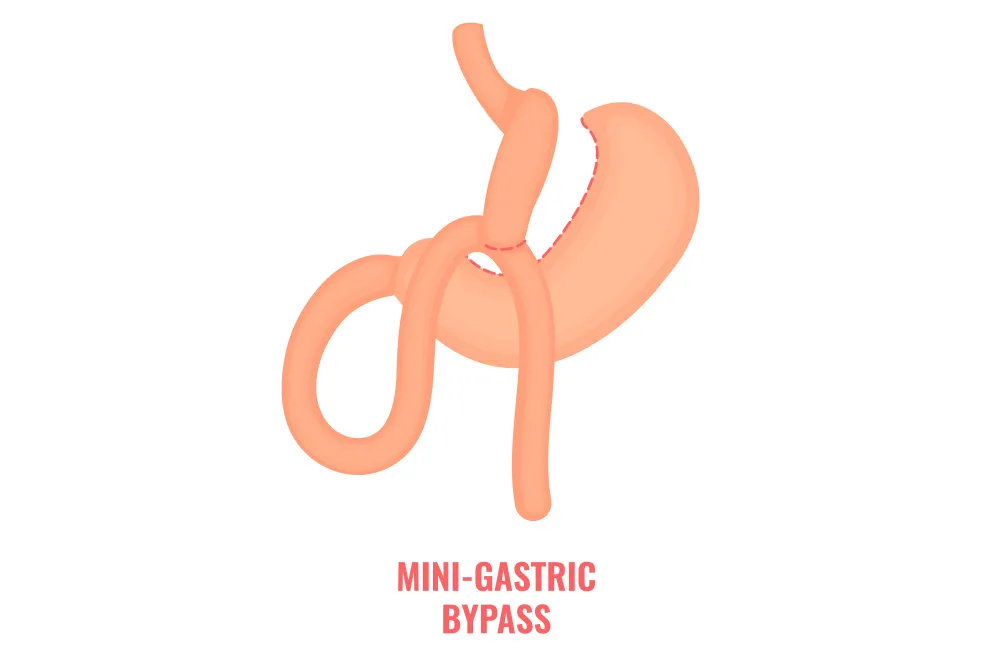 Why-a-Mini-gastric-bypass.webp