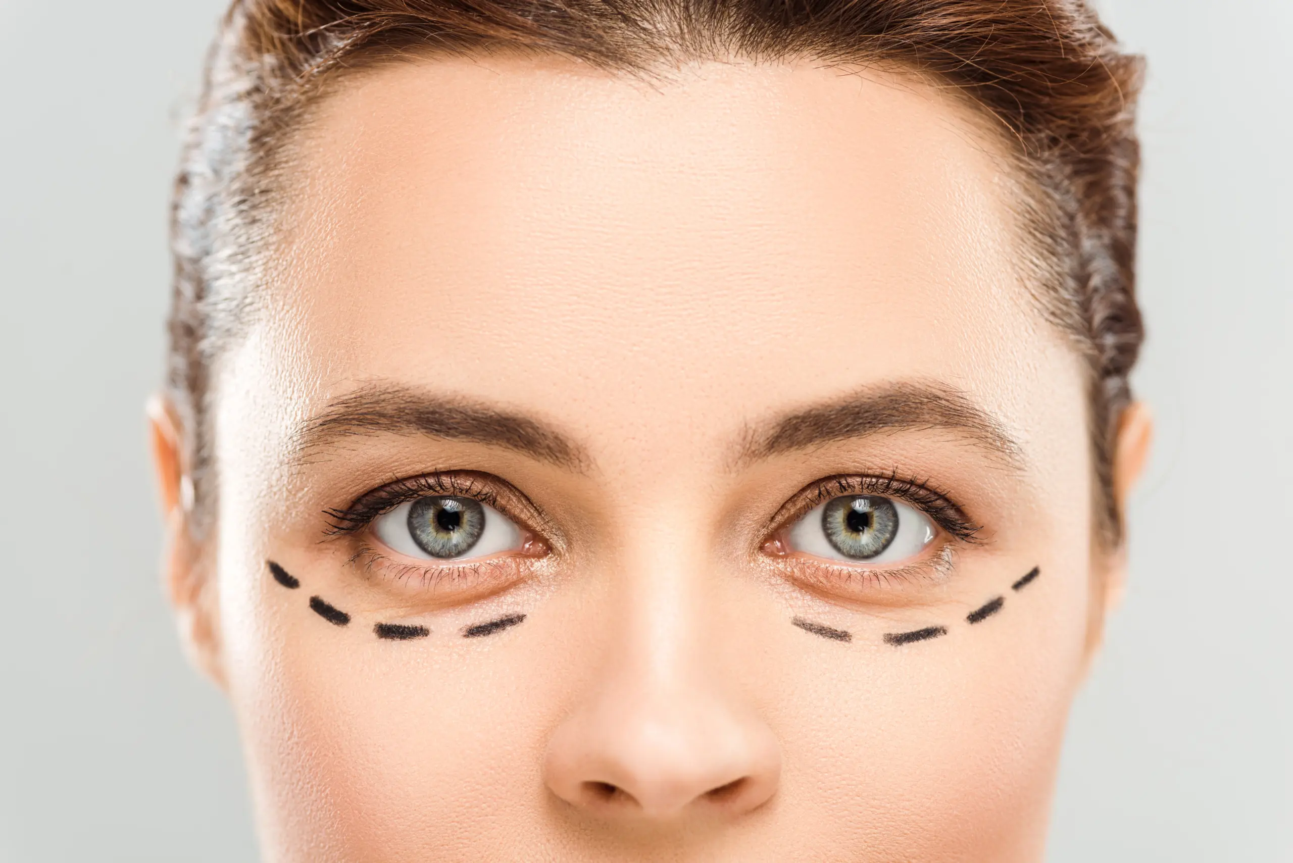 female face with eyes marked for blepharoplasty surgery