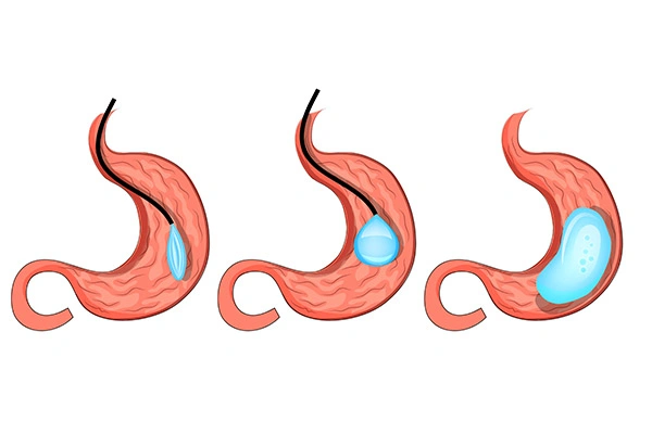 1. You are stuck in a cycle of crash dieting with no results If you have found yourself trying countless new diets and exercise regimes but you are not getting results from these efforts, you are not alone. Diets are often overly restrictive making them hard to stick to over a long time. With a gastric balloon, your appetite is reduced making it easier to make healthier nutritional decisions. You will also have access to a full nutrition plan that is designed by professionals to ensure you are losing weight at a safe pace while still getting adequate nutrition. The gastric balloon ultimately helps you implement new healthier habits that you can continue once the balloon has been removed. Gastric balloon can be thought of as a stepping stone to help you start a healthier life. 2. You would like to try the most conservative approach and avoid surgery A gastric balloon procedure is a day case meaning you won’t have to stay in hospital overnight. It is completed under sedation as opposed to general anaesthetic so you can go home a few hours after your procedure. The balloon is fitted endoscopically so there is no scarring from this procedure. Opting for the least invasive procedure also gives you the option to have a surgical procedure later, if you do not get the desired results from a gastric balloon. 3. You want to improve your overall health and reduce comorbidities Everyone has different reasons for wanting to lose weight but the overall health benefits from losing weight are abundant. From lowering your risk of cardiovascular disease to improving joint pain, weight loss can improve your life and health in all areas. 4. You want to take minimal time off work As there is no general anaesthetic used, patients can return to their regular activities within 5 days. 5. You want the least invasive procedure As previously mentioned this is a day case procedure, there is no general anaesthetic and no scar left post procedure. This procedure is also temporary, there are no permanent changes involved in a gastric balloon procedure 6. You don’t want a procedure that has any permanent changes The gastric balloon is removed at the end of a 6/12 month period and after this your sustained weight loss is reliant on the habits you’ve created while the balloon was inserted. 7. Your BMI falls between 27 and 50 Gastric balloon is an option for patients who are overweight but do not meet the BMI requirements for bariatric surgery. A BMI below 40 is most recommended 8. Your weight is affecting your self confidence Obesity can affect your mental health just as much as your physical health. Patients report higher self confidence following their weight loss. 9. You would like support creating and sticking to healthy habits Gastric balloon is ultimately a temporary procedure that can provide the help you need to change your lifestyle. The biggest risk with gastric balloon is that you will gain weight back when the balloon is removed but evidence has shown that maintaining your weight loss is possible if you continue the prescribed diet and exercise regime post removal. 10. You would like to opt for the lowest cost procedure Gastric balloon is a cheaper procedure as there is no hospital stay required and it is a relatively quick and straightforward procedure. If a gastric balloon sounds like it might be the right fit for you then don’t hesitate to contact Auralia to assess your suitability or get answers for any questions you have.